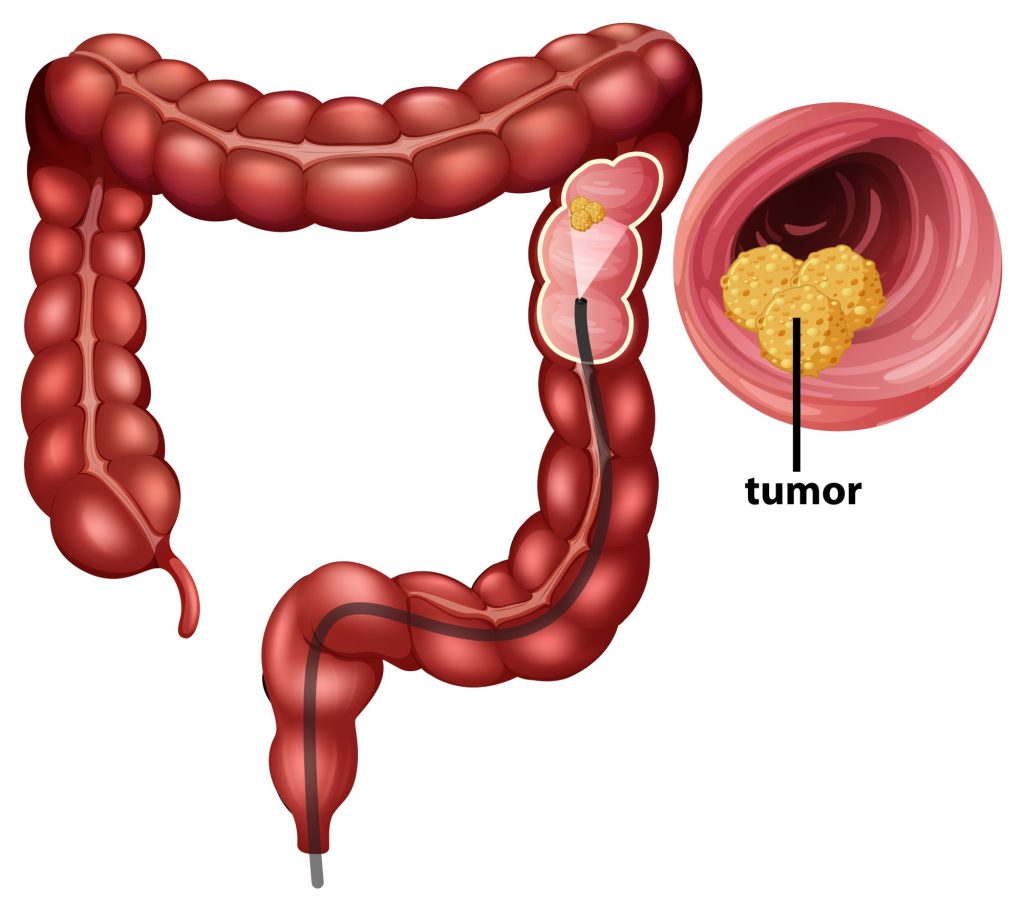 Kolorektal cancer